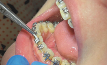 Da li aparat može oštetiti gleđ?