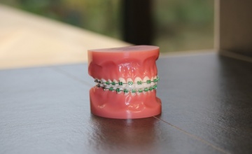 Fiksni ortodontski aparati - bol ili nelagodnost?    