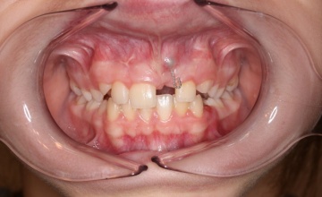 Impaktirani (uklješteni) zubi i ortodontski tretman