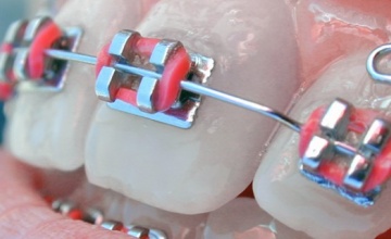 Koliko često menjati gumice na fiksnom ortodontskom aparatu?